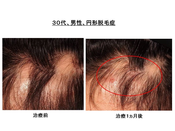 円形脱毛症　病院""